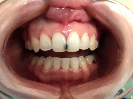 Interproximal tooth decay between upper front central incisors before composite resin treatment.