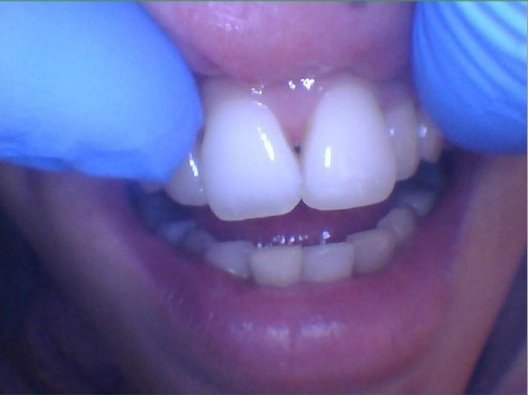 A beautifully restored tooth-colored composite resin filling on an upper central incisor's incisal edge.