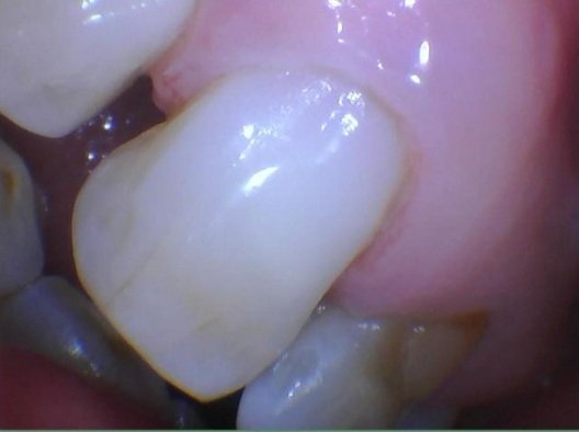 Completed tooth-colored composite resin restoration blending naturally with the surrounding enamel.