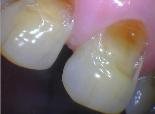 Close-up intraoral view of a type of fracture (abfraction) along the gumline before composite filling treatment.