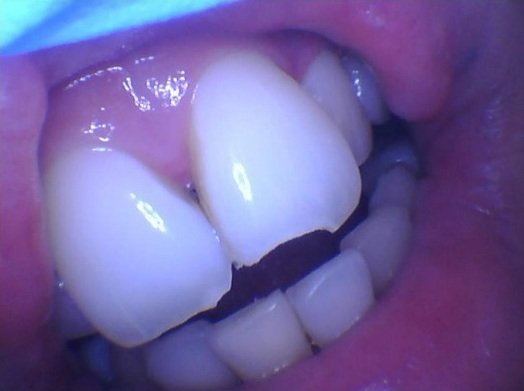 Close-up intraoral photo showing a chipped incisal edge on an upper central incisor before composite resin restoration.