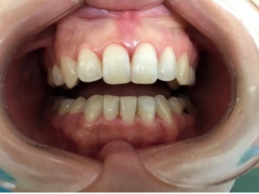 Upper front incisors smoothly restored with tooth-colored composite resin matching natural tooth shade.