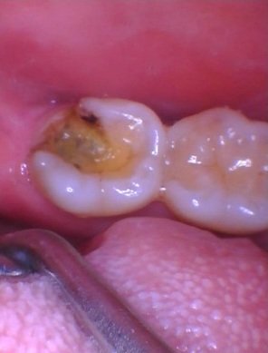 Intraoral view of a lower molar with extensive decay and missing tooth structure.