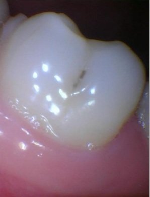 Buccal cavity on the lower molar.