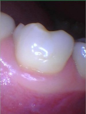 Buccal white composite filling placed and polished on the lower molar.