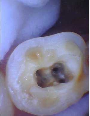 Intraoral photograph looking inside the pulp chamber of a prepared tooth showing root canal orifices.