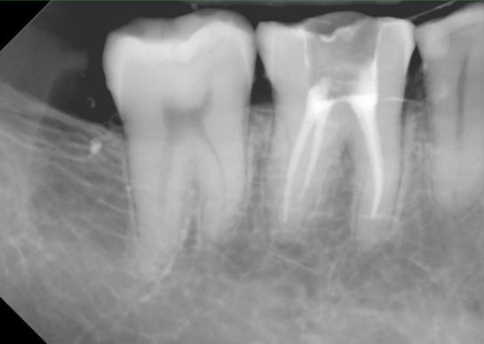 Dental X-ray showing a completed root canal obturation on a lower molar.