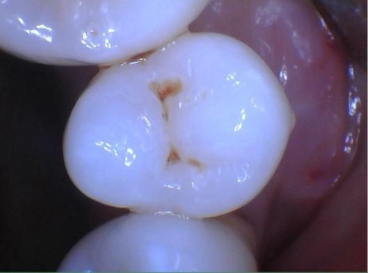 Close-up intraoral photo showing dark pit and fissure decay on the chewing surface of a premolar.