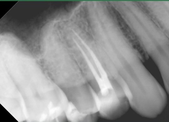 Completed root canal X-ray on a upper premolar with two root canals.