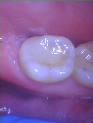 Seamlessly rebuilt lower molar restoring full anatomical shape and chewing surface with a ceramic onlay restoration.